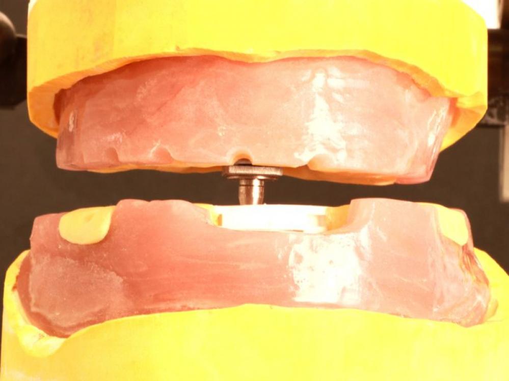 IPR-Schablonen für die Messung bei zahnlosen Kiefer