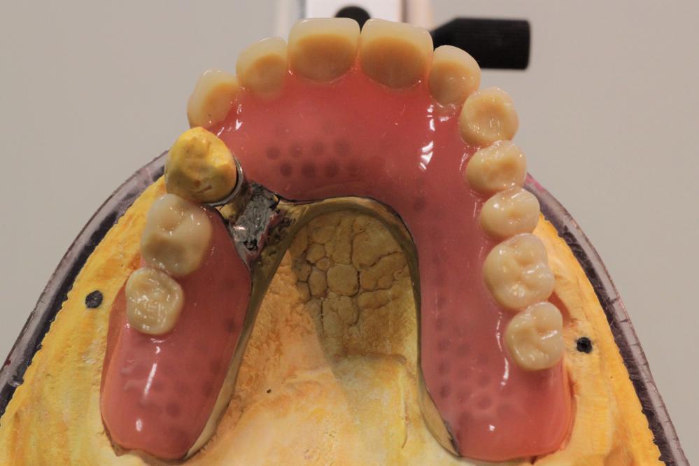 OK Prothese auf 4 Implantaten, 1 Zahn 